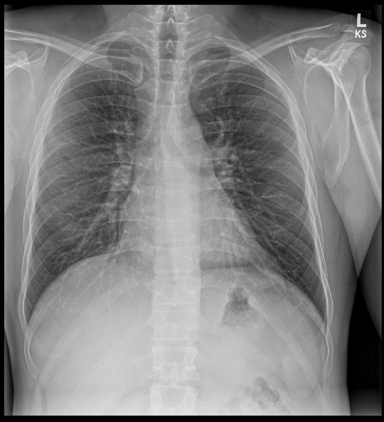 Fictional frontal chest X-ray study